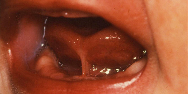 Photo of a baby's mouth with tongue tie 